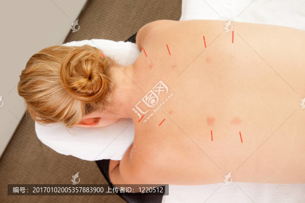 后Shu,Acupuncture點