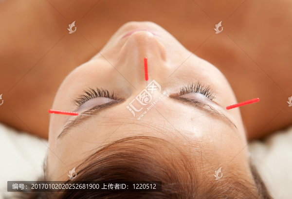 抗衰老針刺療法