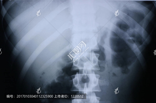 X射線/脊柱3