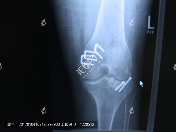 膝關(guān)節(jié)重建