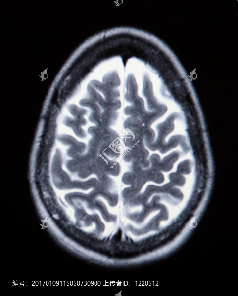 一個(gè)真正的MRI或MRA（磁共振血管造影）的腦血管（動(dòng)脈）單色