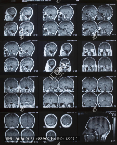 腦MRI