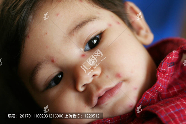 嬰兒水痘小男孩