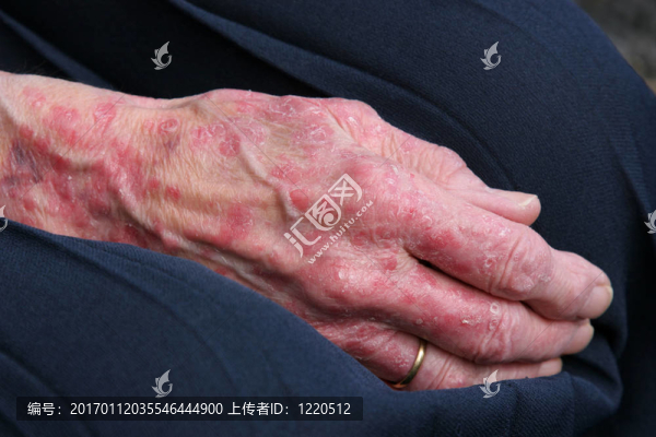 sceriosis