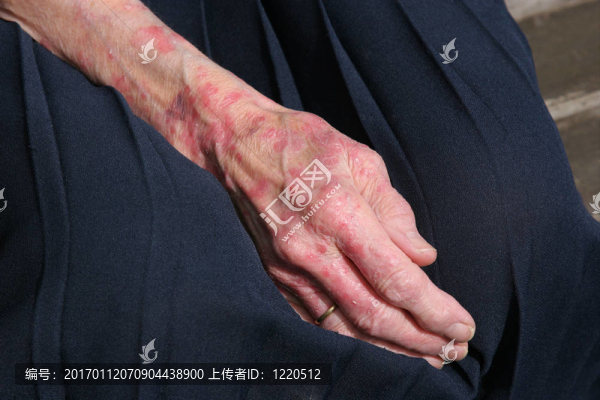 sceriosis皮膚狀況