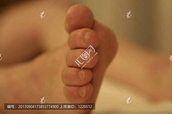 knubbel腳趾