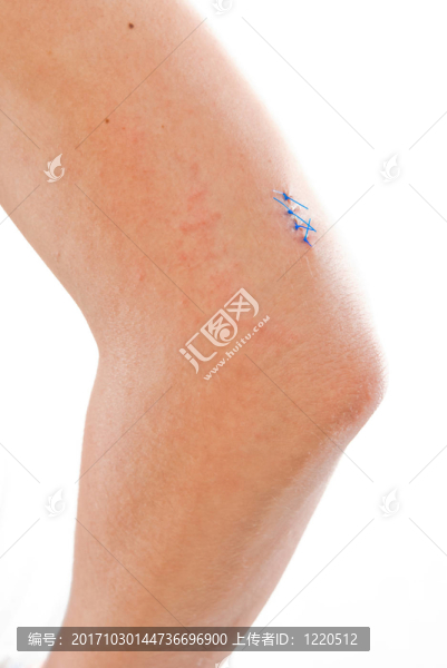 stitched,up,injury