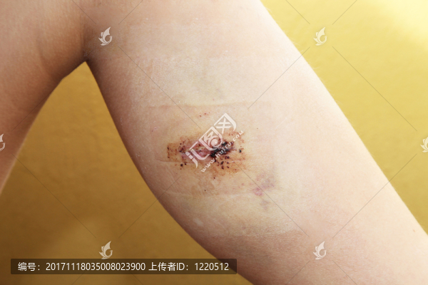 腿部損傷,-,用縫線纏繞
