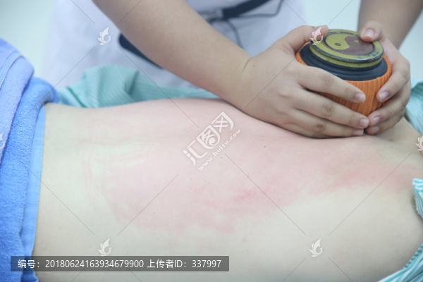 火龍罐灸