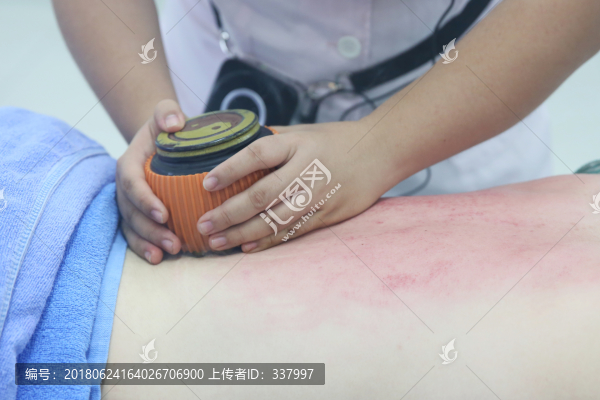 火龍罐灸