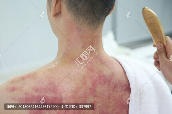 銅砭刮痧