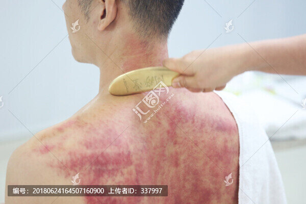 銅砭刮痧