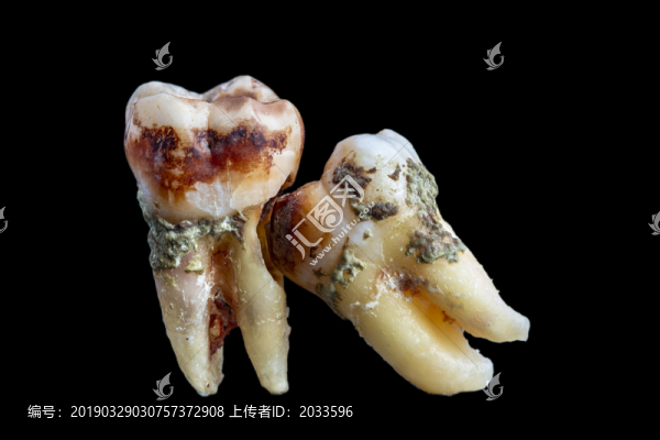 智齒擠壓第二磨牙親密合照