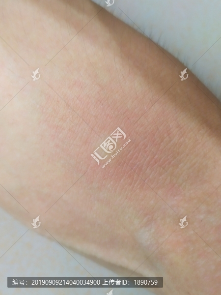 蚊子包