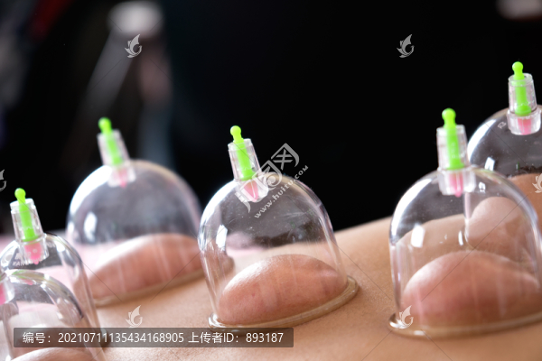 中醫(yī)保健拔罐
