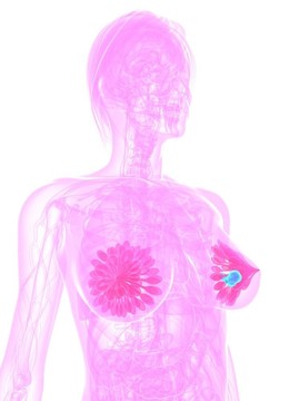 乳腺癌的插图